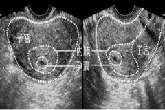 胎儿的性别预测，孕囊的形状看男女真的准吗?